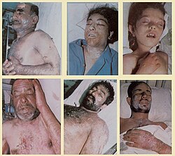Victims of the 1987 chemical attack on Sardasht, West Azerbaijan, Iran