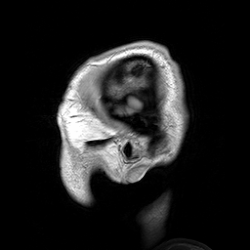 Sagittal sections of the head as seen by a modern MRI scan