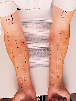 A 21-year-old male arms during an allergy skin test. A visible raised, red wheal indicates a positive allergic reaction. The positive control (H) shows a strong reaction, while the negative control (C) shows no visible response.