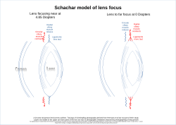 Schachar model of lens focus