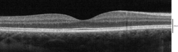 Spectral-domain OCT macula cross-section scan