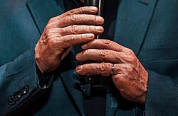 Lula had his left little finger amputated after a work-related accident when he was a metalworker in 1964.