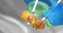 Electrode reconstruction generated with Lead-DBS. The picture shows two electrodes implanted into the subthalamic nucleus (orange) for treatment of Parkinson's disease. Other structures: Stimulation volumes (red), internal (green) and external (cyan) parts of the pallidum.