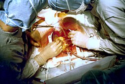 Coronary artery bypass surgery during mobilization (freeing) of the right coronary artery from its surrounding adipose tissue (yellow). The tube visible at the bottom is the aortic cannula, which returns blood from the heart–lung machine. The tube above it (obscured by the surgeon on the right) is the venous cannula, which receives blood from the body. The patient's heart is stopped and the aorta is cross-clamped. The patient's head (not seen) is at the bottom.