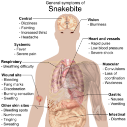 Most common symptoms of any kind of snake bite envenomation.[126][127] Furthermore, there is vast variation in symptoms between bites from different types of snakes.[126]